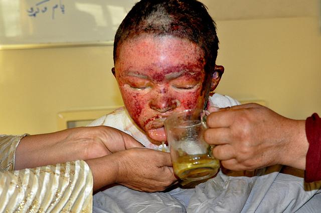 Burning Injuries on the Face of Girl