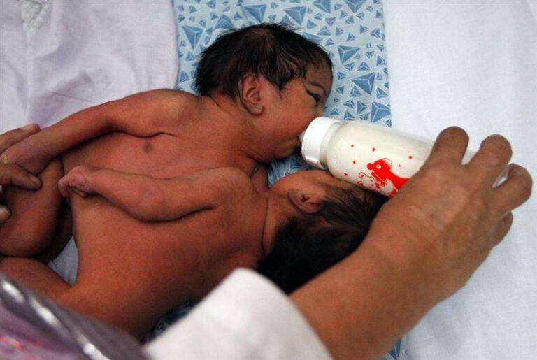 Conjoined twin girls born in Nangarhar