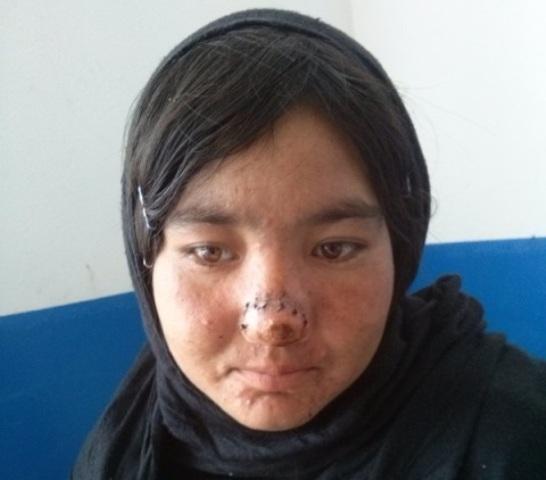 بينى يک زن در دايکندى توسط شوهرش بريده شد