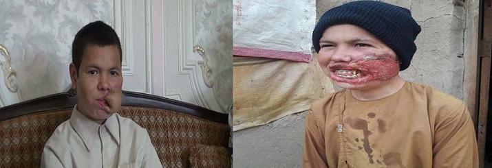 کودک صحت ياب شده: آرزو دارم مکتب بروم و انجنير شوم