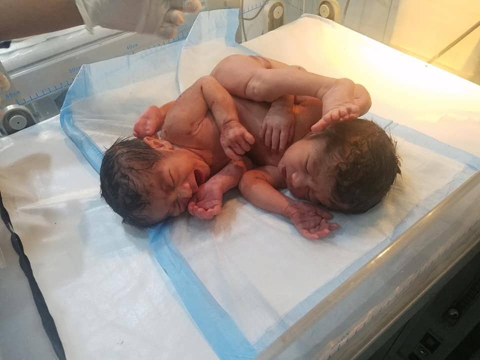 دو کودک به هم چسپیده دوگانه گی در هرات متولد شده است