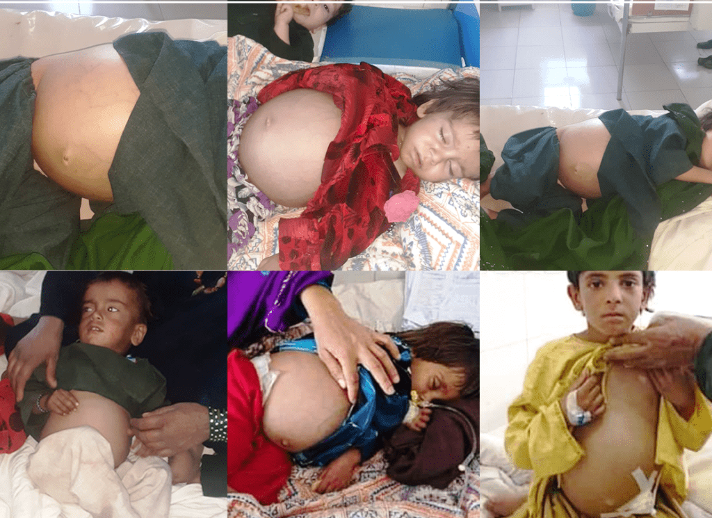 Mysterious disease causes stomach distension among dozens of Helmand children