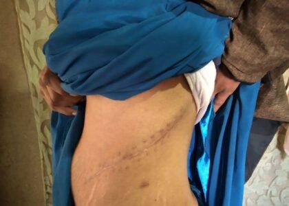 I sold my kidney despite being pregnant: Khori Gul