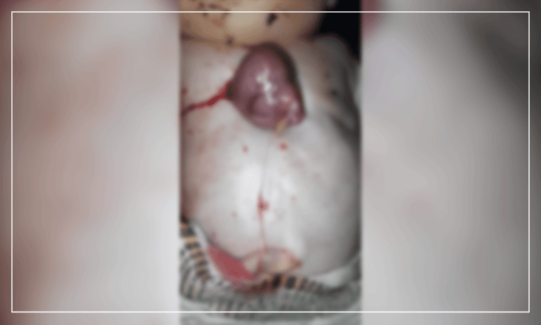 Baby with heart outside chest survives for 7 hours