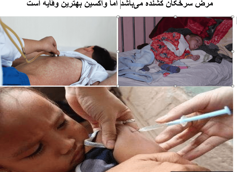 وزارت صحت‌عامه: در بیش از یک ماه گذشته، ۴۵ کودک از اثر سرخکان جان باخته‌اند