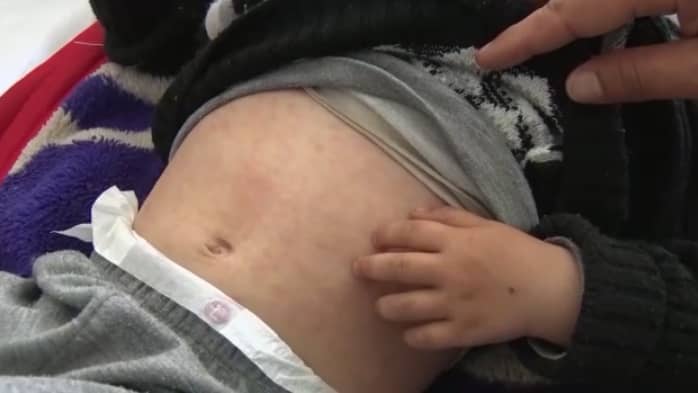 157 children died of measles in Badakhshan’s Nasi, Kuf districts