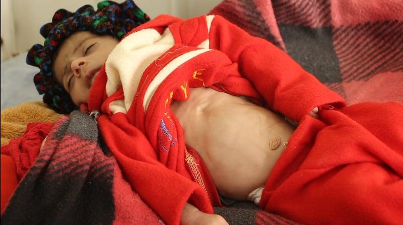 Nearly a dozen children die of malnutrition in Kunduz