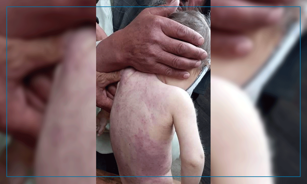 طى يک ماه، پنج کودک در تخار به اثر بيمارى سرخکان جان باخته‌اند