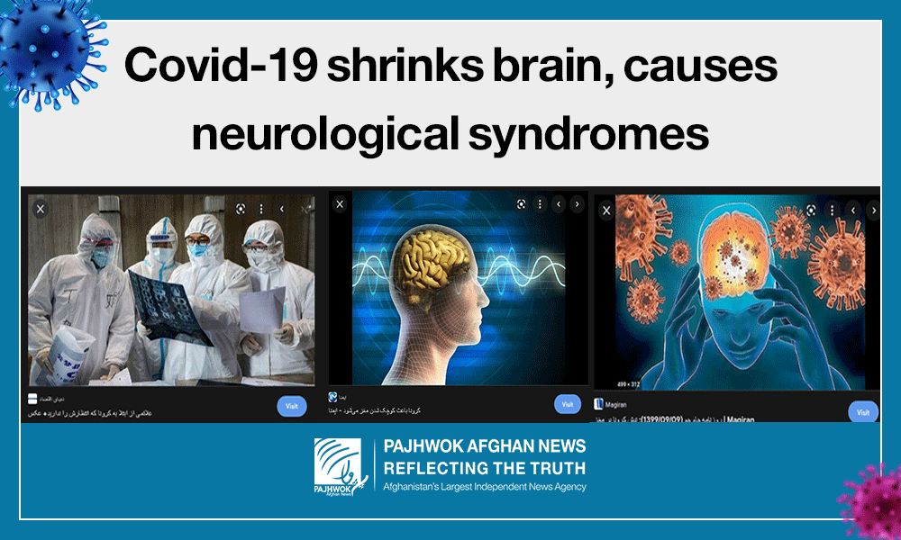 Covid-19 shrinks brain, causes neurological syndromes