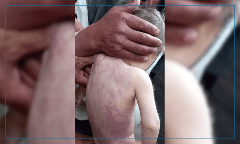  واقعات مثبت بیماری سرخکان در بادغیس نسبت به سال گذشته سه برابر افزایش یافته‌است