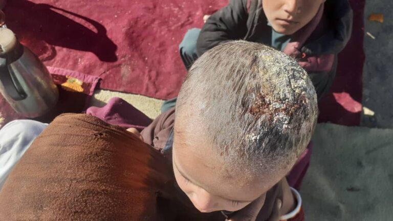 New disease spreads in Shinkai district of Zabul