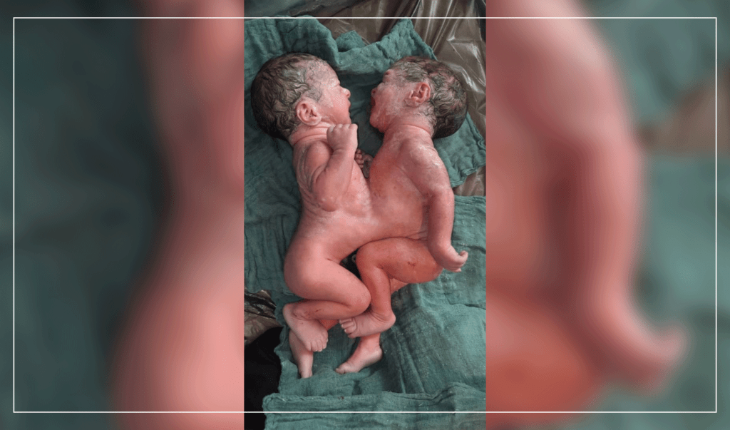 تولد دو کودک به هم چسپیده در میدان وردگ