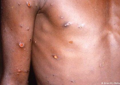 Fully prepared to fight monkeypox disease: MoPH