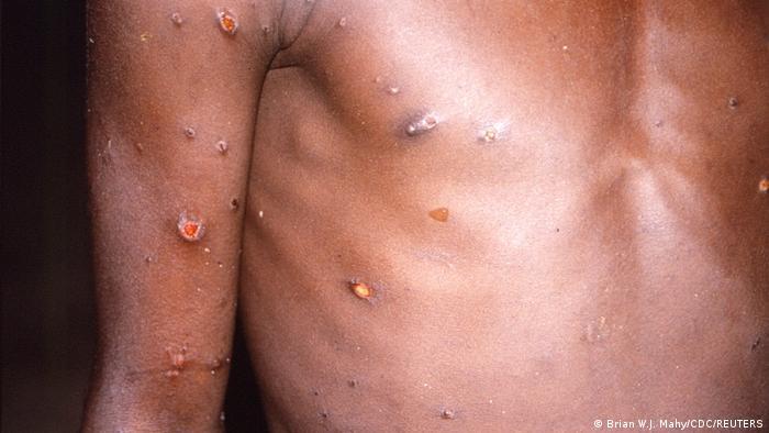 Fully prepared to fight monkeypox disease: MoPH