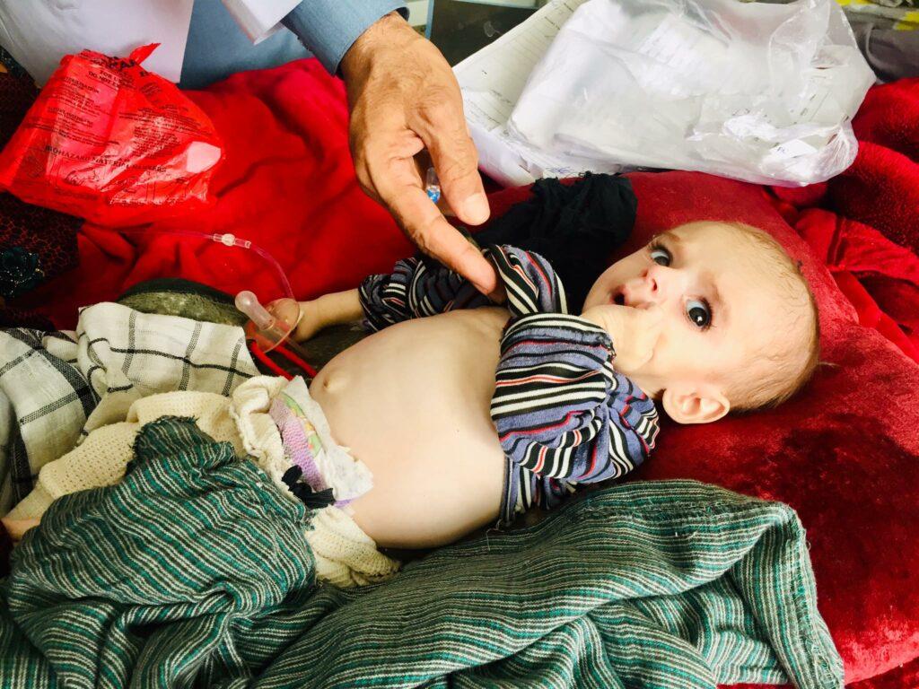 775 malnourished children hospitalized in Balkh last year
