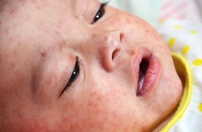 مسئولان صحی: ۷۹ درصد از کودکان در دایکندی واکسین سرخکان را دریافت کرده اند