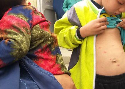 About 1,000 children infected with smallpox in Baghlan