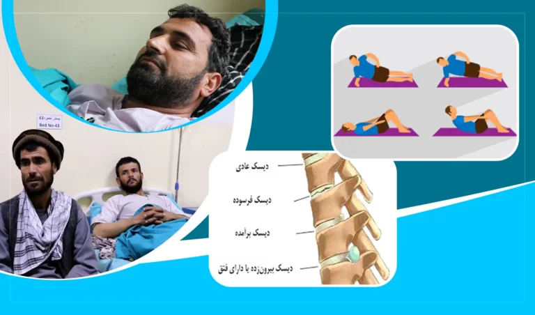 داکتران: اگر دیسک کمر به‌‌موقع تداوی نشود، می‌تواند مریض را فلج سازد