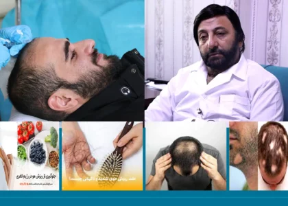 ‘Mental pressure main factor behind hair loss’