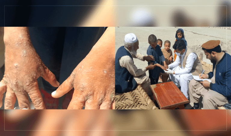 80 Laghman students suffer from Scabies