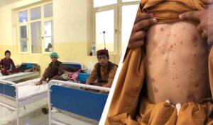 Balkh Hospital records 20pc increase in skin patients