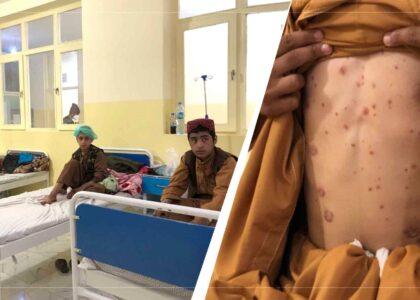 Balkh Hospital records 20pc increase in skin patients