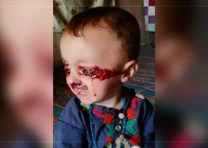 Medical mystery: Uruzgan child sheds tears of blood