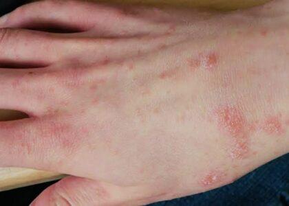 Nangarhar records 25 scabies outbreaks this year
