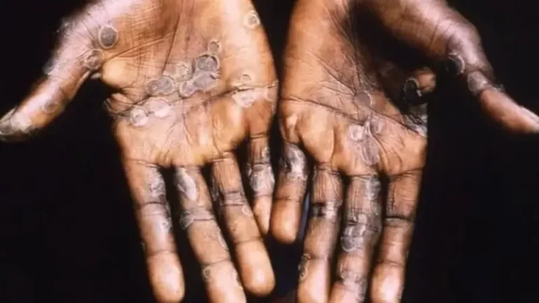 Sweden registers first case of more dangerous mpox