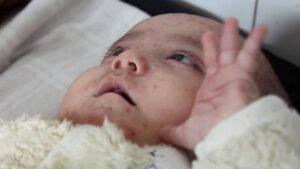 مبتلاشدن بیش از ۴۰۰ کودک به سرخکان در غور؛ دو کودک از اثر این بیماری جان باخته‌اند