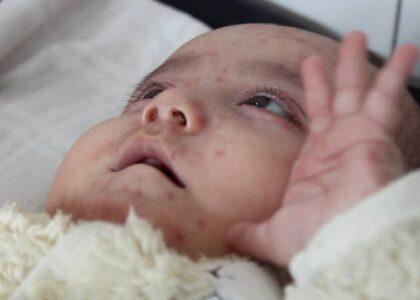 400 Ghor children suffer from measles in 11-month