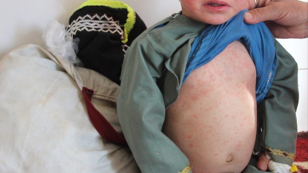 Ghor records above 300 measles cases in 3 months