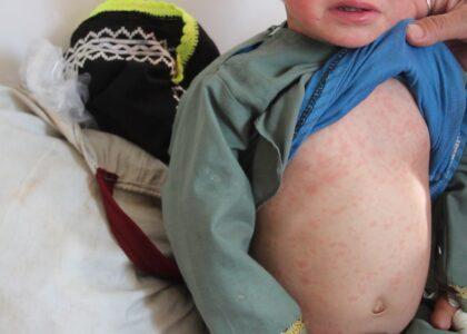 Ghor records above 300 measles cases in 3 months