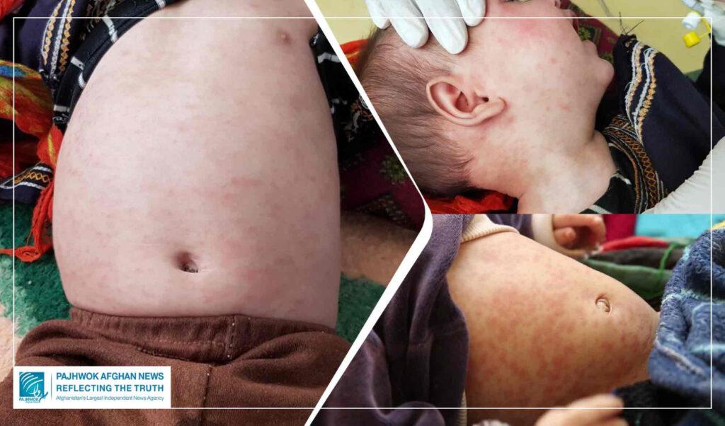 Rise in measles cases in Ghor: Hundreds of children hospitalised in 10 months