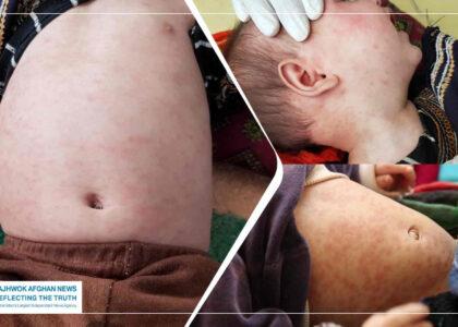 Rise in measles cases in Ghor: Hundreds of children hospitalised in 10 months
