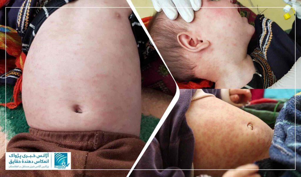 افزایش موارد سرخکان در غور؛ بستری‌شدن صدها کودک در ده ماه گذشته