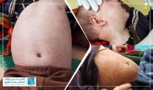 افزایش موارد سرخکان در غور؛ بستری‌شدن صدها کودک در ده ماه گذشته
